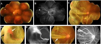 Retinal hemangioblastoma in a patient with Von Hippel-Lindau disease: A case report and literature review